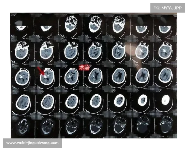 佐佐木尽CT扫描排除脑出血，短暂失忆六周后已出院恢复
